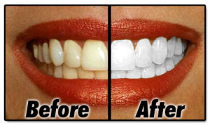 before-after-white-teeth